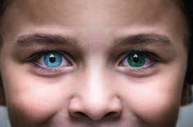 Heterochromia FAQs - All About Vision