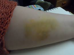 Bruises using Glynn McKay Bruise Gels | bex's makeup box